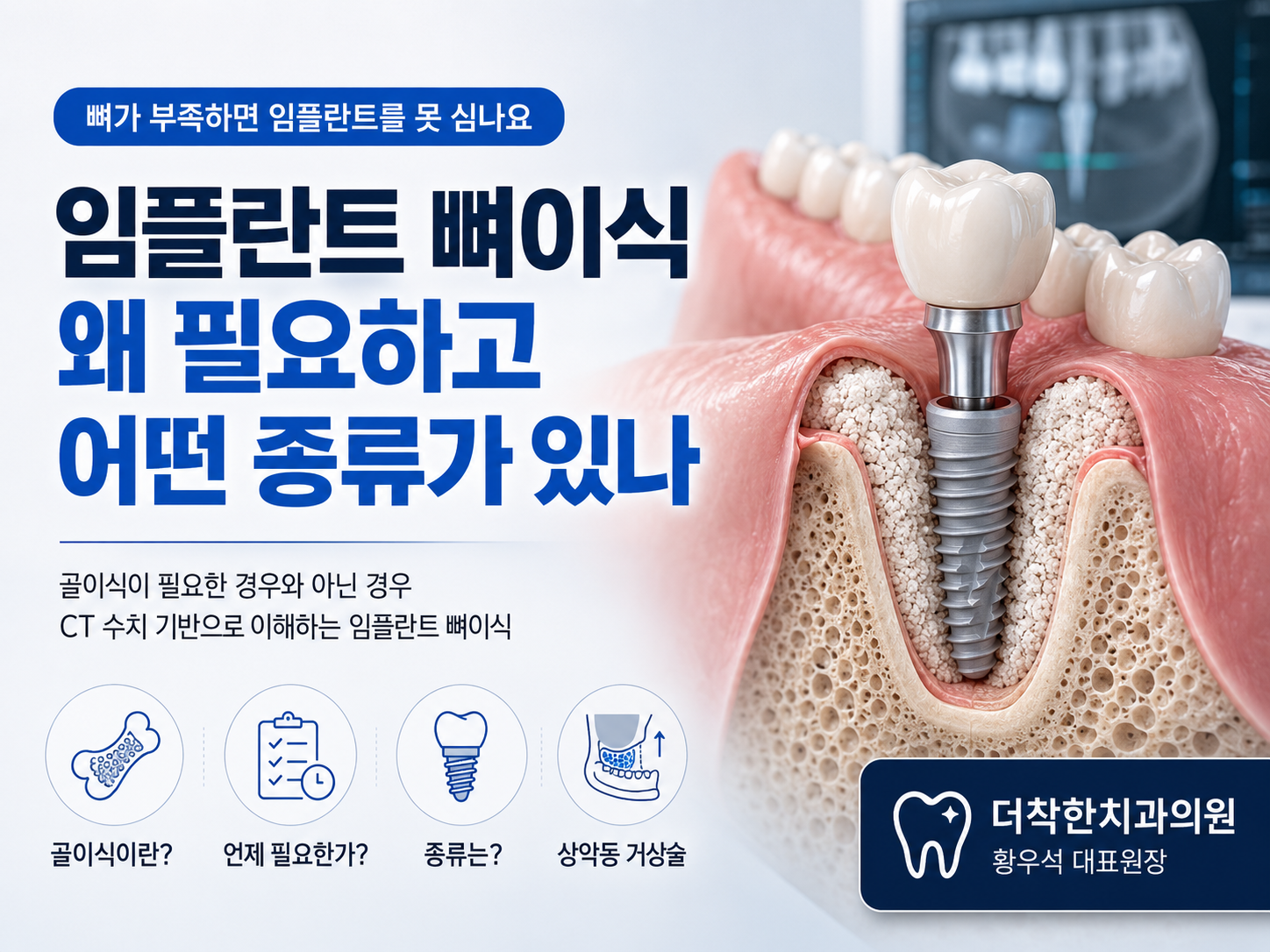 뼈이식 꼭 해야 한다”는 말, 그냥 받아들이지 마십시오