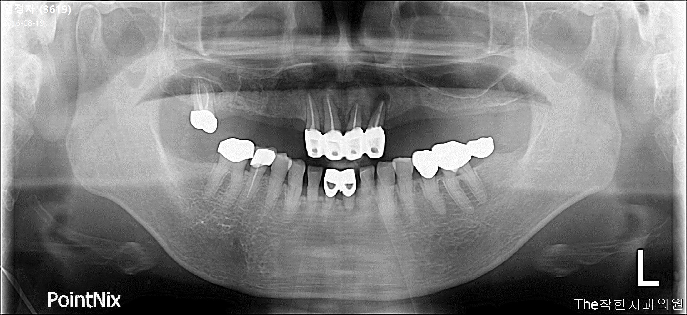 불편한 틀니는 빼고, 네비게이션 임플란트로 치료하기 파노라마 (전)