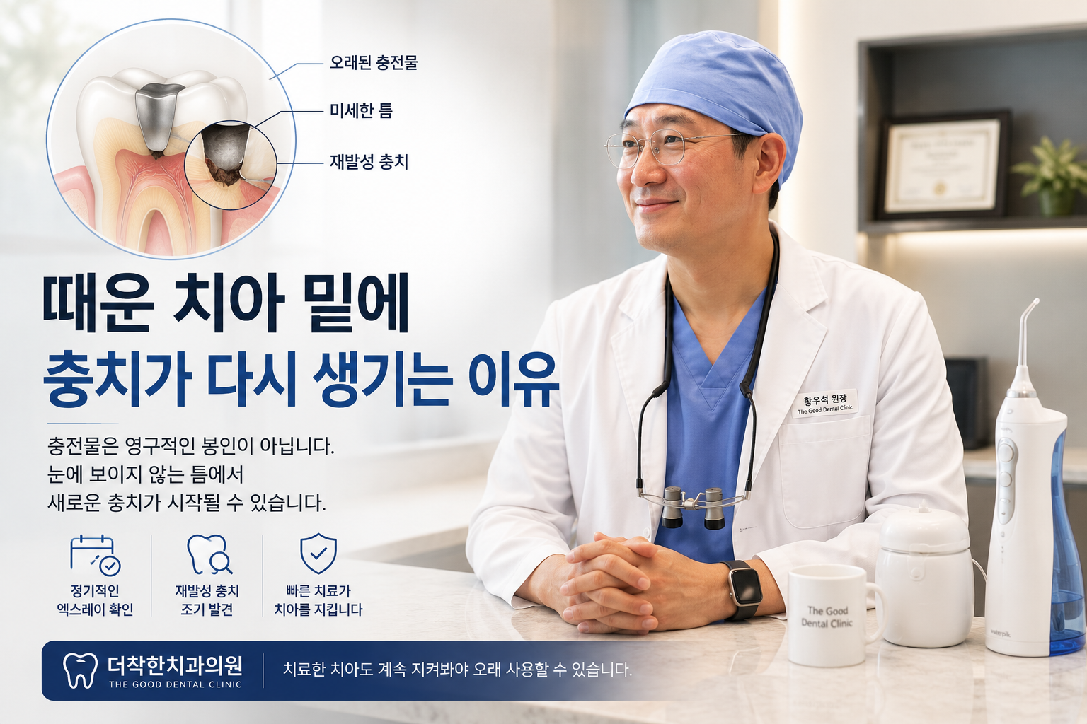 때운 치아 밑에 충치가 다시 생기는 이유
